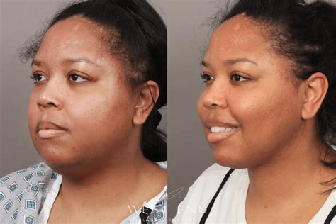 buccal fat removal 10 years later|I Had Buccal Fat Removal, I Deeply Regret It